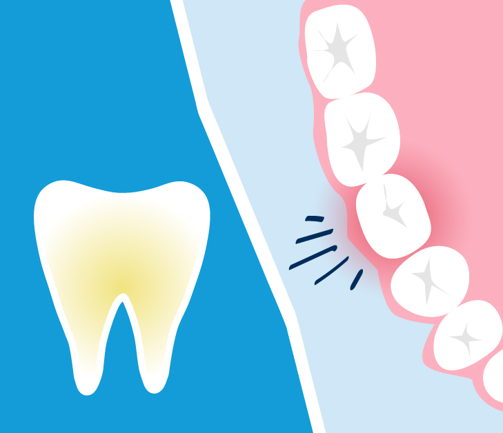 The Main Causes of Root Canal Infections